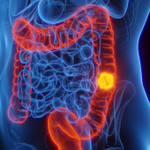 Ung thư đại trực tràng "trẻ hóa", người dưới 50 tuổi đối mặt nguy cơ lớn