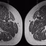 Mỡ len lỏi vào cơ bắp bởi thực phẩm siêu chế biến