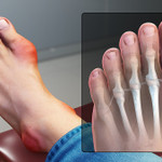 Ăn Tết khéo để tránh cơn gút hành hạ