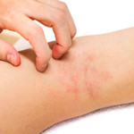 Nuôi dưỡng cơ thể đúng cách để hạn chế viêm da cơ địa tái phát