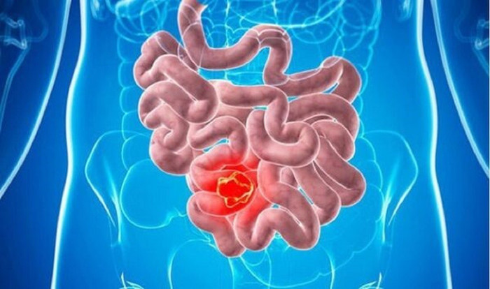 Bệnh viêm ruột là nhóm bệnh gây viêm mạn tính ở đường tiêu hóa benh-ibd-1-1-1.jpg