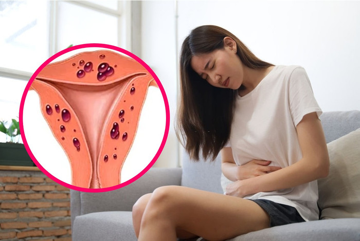 Người bệnh thường gặp các triệu chứng liên quan đến chu kỳ kinh nguyệt lacnoimac.png