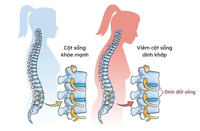 Viêm cột sống dính khớp gây ảnh hưởng lớn đến cột sống viem-cot-song-dinh-khop-1-3.jpg