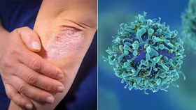 Vảy nến không chỉ là bệnh về da – Những rủi ro đang bị bỏ quên!