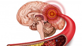 Triệu chứng nhồi máu não: Nhận biết sớm để tránh hậu quả nặng nề