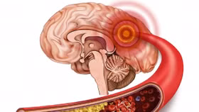 Triệu chứng nhồi máu não: Nhận biết sớm để tránh hậu quả nặng nề