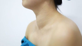 Cách cải thiện bướu cổ đơn thuần: Giải pháp an toàn, hiệu quả từ chuyên gia