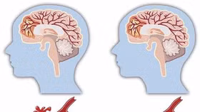 Tai biến mạch máu não có hồi phục được không?