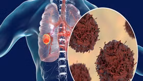 Nguyên nhân gây u phổi và giải pháp hỗ trợ từ thảo dược