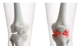 6 nguyên nhân thoái hóa khớp thường gặp và cách phòng ngừa hiệu quả