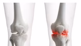 6 nguyên nhân thoái hóa khớp thường gặp và cách phòng ngừa hiệu quả