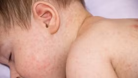 Bé bị rôm sảy: Mẹ chăm sóc da cho con thế nào?