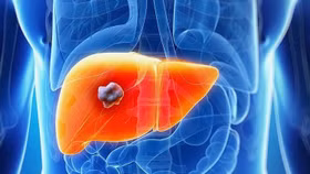 U gan - Nguyên nhân, dấu hiệu nhận biết và cách điều trị hiệu quả 