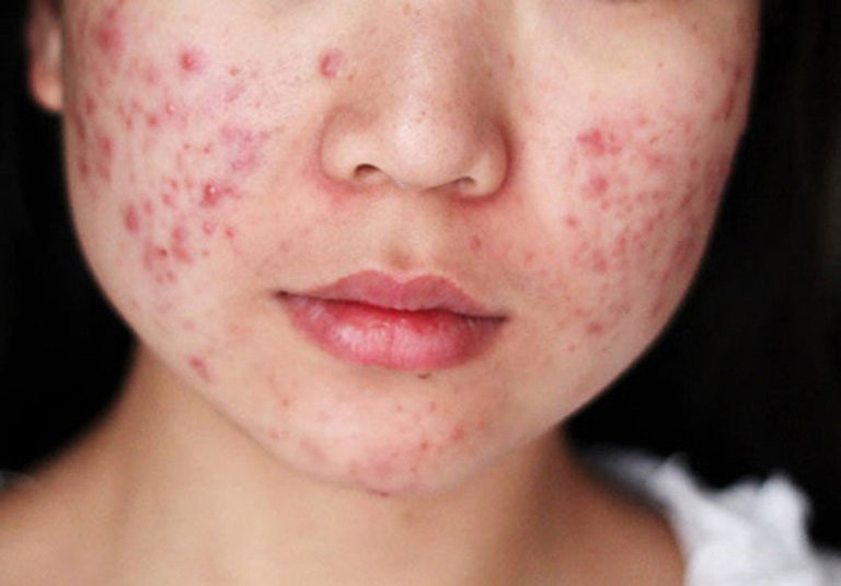 Mụn viêm dễ bùng phát trong mùa hè nếu không làm sạch và chăm sóc da đúng cách mun-viem.jpg