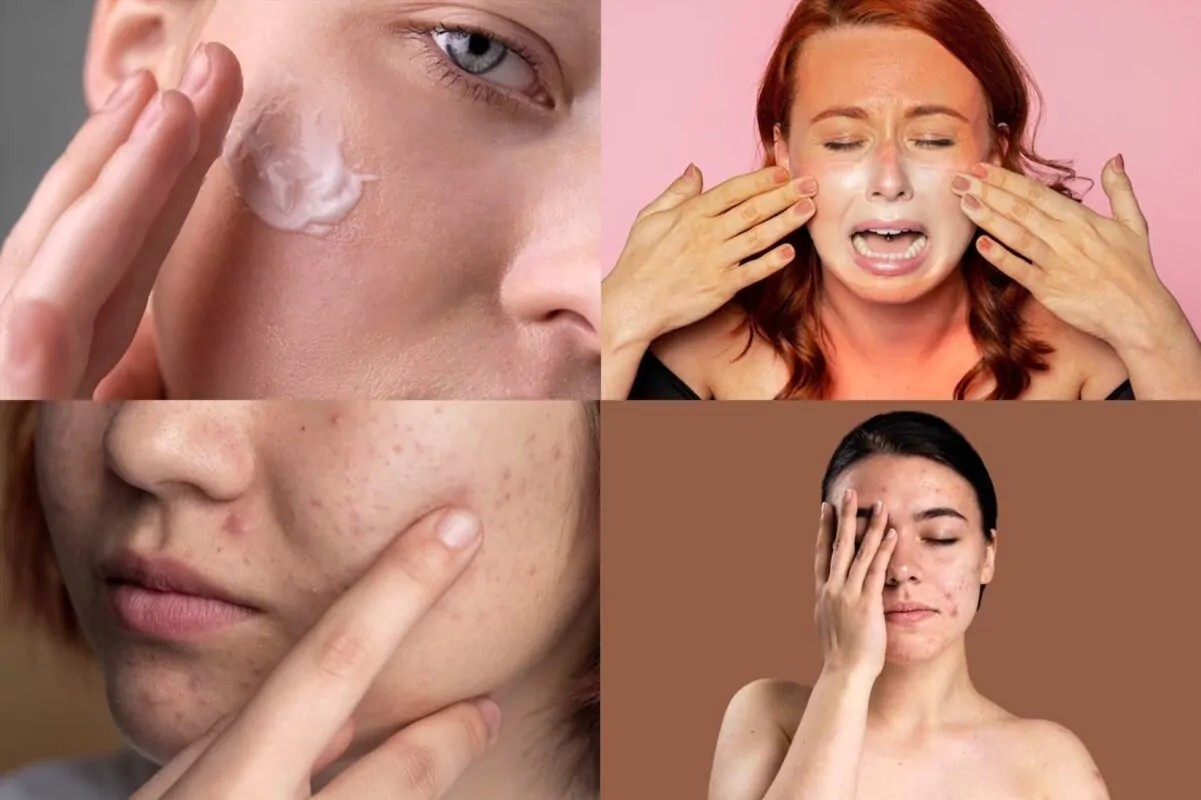 Mùa hè là thời điểm làn da đối mặt với nhiều vấn đề đáng lo ngại (Ảnh minh họa) van-de-ve-da-1201x800.jpg