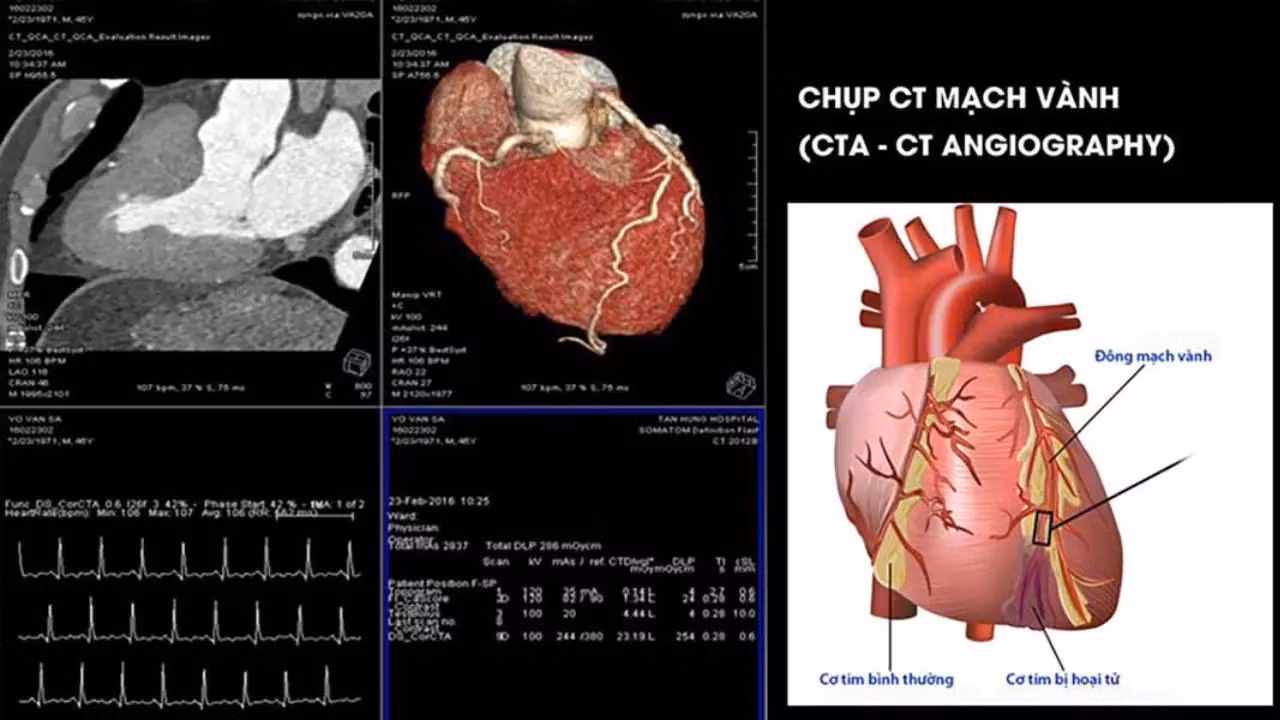 chup-ct-mach-vanh-1.jpg
