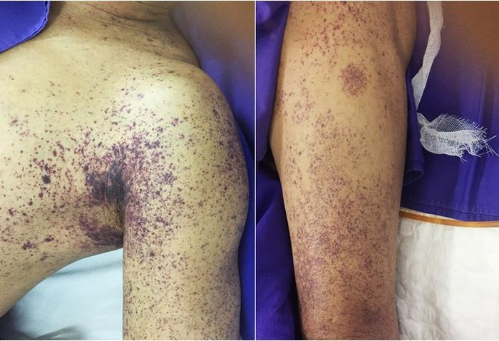 Ban xuất huyết trên da do liên cầu lợn 20210704-nkh.jpg