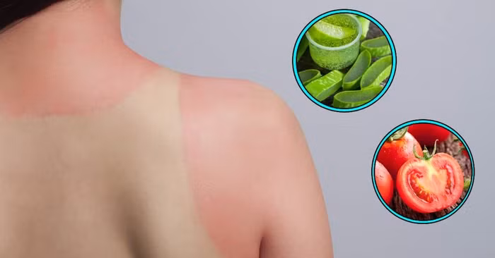 Cách chữa da cháy nắng hiệu quả tại nhà