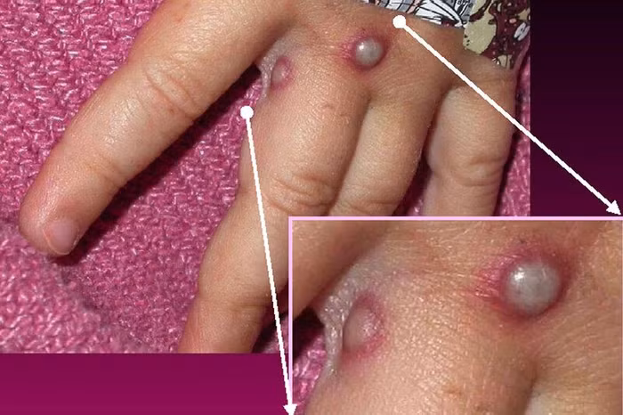 monkeypox