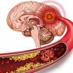 Triệu chứng nhồi máu não: Nhận biết sớm để tránh hậu quả nặng nề