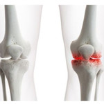 6 nguyên nhân thoái hóa khớp thường gặp và cách phòng ngừa hiệu quả