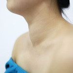 Cách cải thiện bướu cổ đơn thuần: Giải pháp an toàn, hiệu quả từ chuyên gia