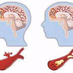 Tai biến mạch máu não có hồi phục được không?
