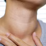 Nguyên nhân bướu cổ: Không chỉ do thiếu i-ốt như nhiều người vẫn nghĩ