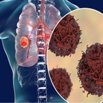 Nguyên nhân gây u phổi và giải pháp hỗ trợ từ thảo dược