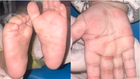 Trẻ đến viện với biểu hiện ban đỏ rải rác ở lòng bàn tay và chân