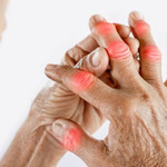 Bệnh thấp khớp có thể trở thành "sát thủ thầm lặng" gây tổn thương tới cả tim, phổi và thận 