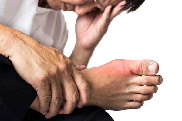 Khi bị gút, các khớp ngón chân thường bị viêm, sưng, đau nhức l2.png