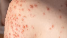 Nhiều ổ dịch thủy đậu xuất hiện: Cần làm gì để phòng tránh?