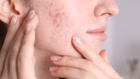 5 món ăn giúp hồi sinh làn da, đánh bay mụn từ bên trong