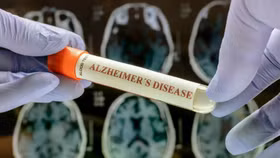 Phát hiện khoa học mới mở ra hy vọng kiểm soát bệnh Alzheimer