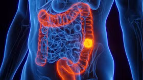 Ung thư đại trực tràng "trẻ hóa", người dưới 50 tuổi đối mặt nguy cơ lớn