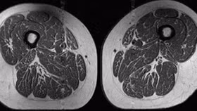 Mỡ len lỏi vào cơ bắp bởi thực phẩm siêu chế biến