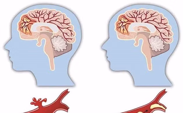 Tai biến mạch máu não có hồi phục được không?