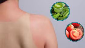 Cách chữa da cháy nắng hiệu quả tại nhà