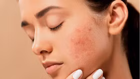 Những bí quyết giúp phòng tránh mụn ẩn hiệu quả