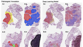 Trí tuệ nhân tạo có thể phát hiện nhanh và chính xác ung thư phổi