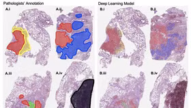 Trí tuệ nhân tạo có thể phát hiện nhanh và chính xác ung thư phổi