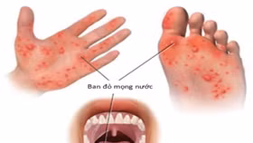 Vi rút Enterovirus 71 đã trở lại gây ra bệnh tay chân miệng ở trẻ em
