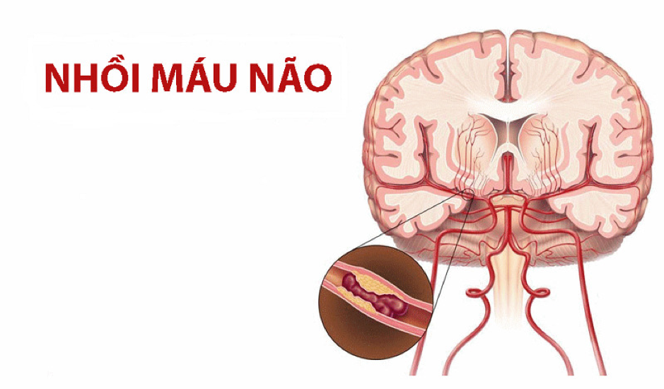 Đột quỵ do nhồi máu não gây tổn thương nặng nề cho não bộ và cơ thể picture1-9540.png
