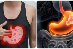 5 triệu chứng buổi sáng cảnh báo ung thư dạ dày
