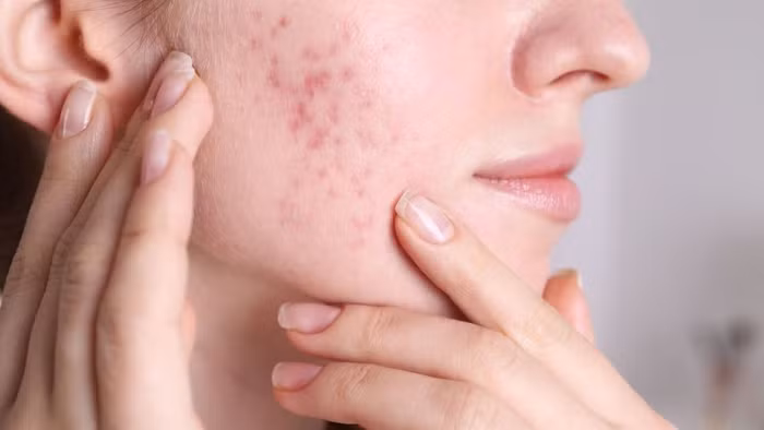 5 món ăn giúp hồi sinh làn da, đánh bay mụn từ bên trong