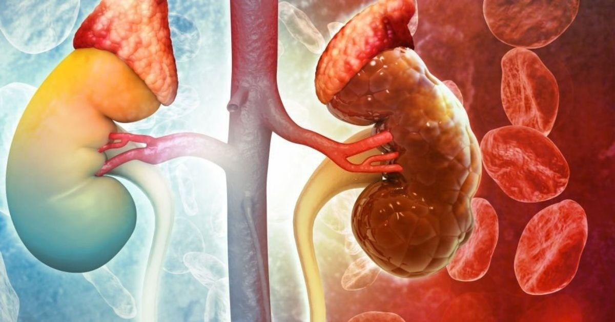 Bệnh thận thường không gây ra triệu chứng quá rõ ràng gì cho tới khi đã tiến triển đến giai đoạn nguy hiểm suy-than.jpg