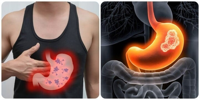 5 triệu chứng buổi sáng cảnh báo ung thư dạ dày