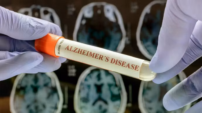 Phát hiện khoa học mới mở ra hy vọng kiểm soát bệnh Alzheimer